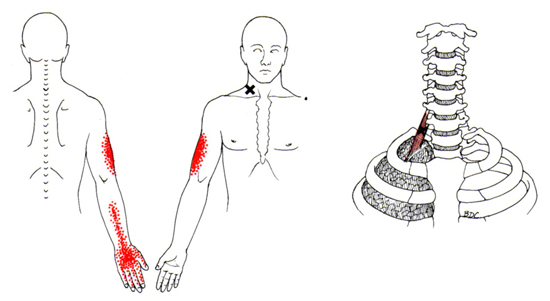 engourdissement aux mains