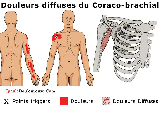 douleur au bras 