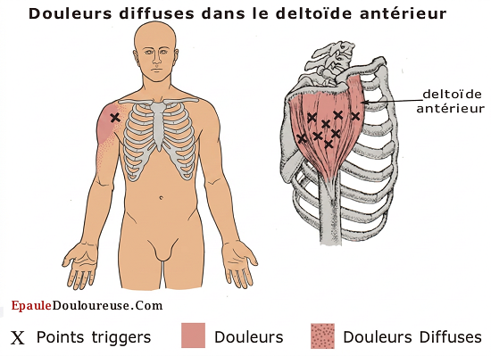 prudence points gâchettes