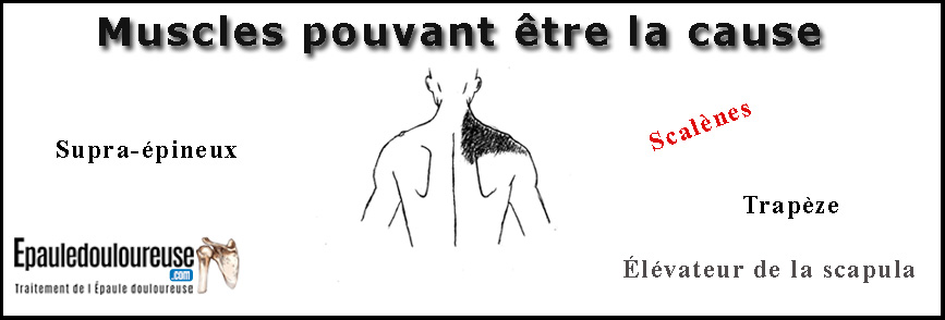 douleur dessus épaule