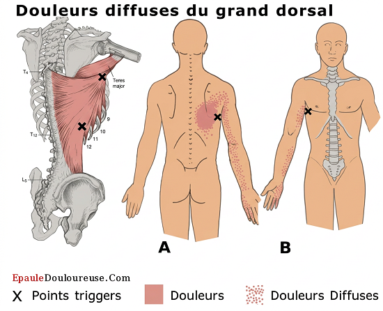 douleur dos