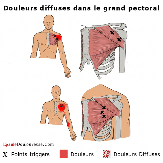 douleur angine poitrine