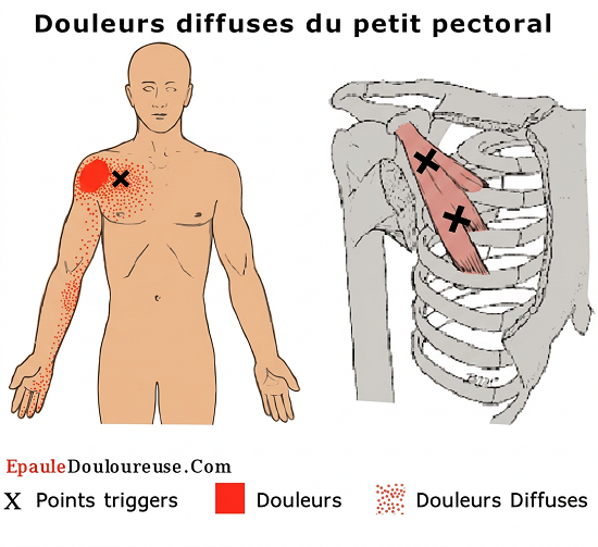 points trigger dans le petit pectoral