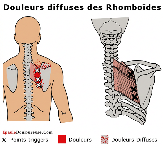 douleur dos