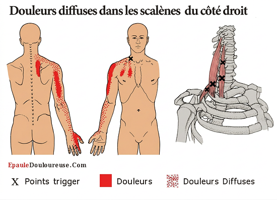 syndrome du canal carpien