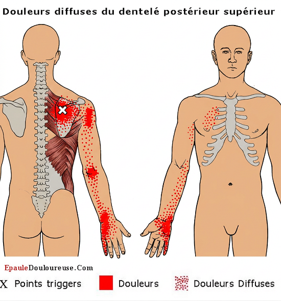 douleur dans le haut du dos
