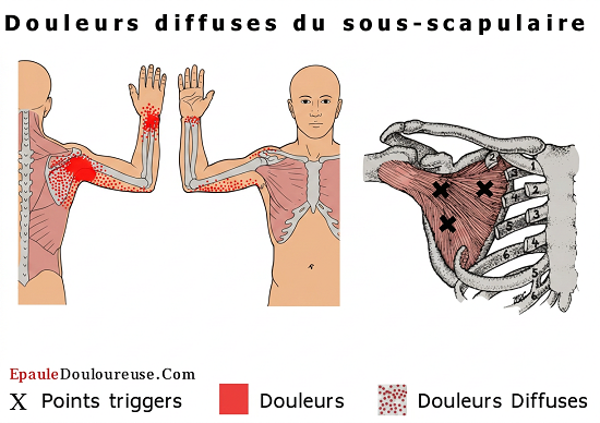 douleur épaule gelée