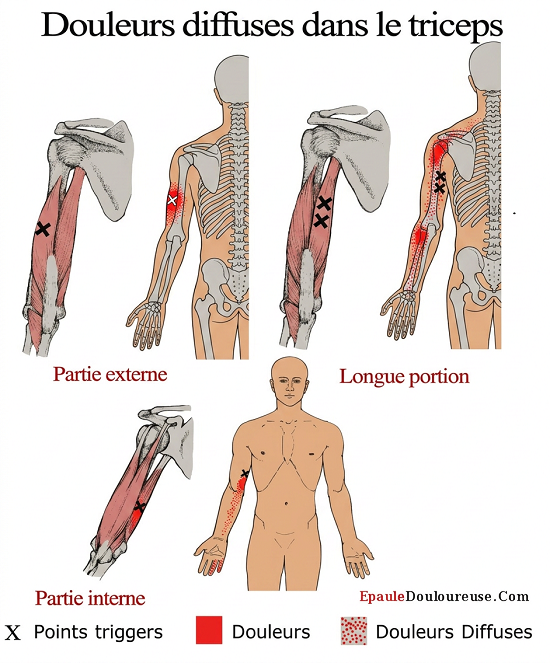 triceps