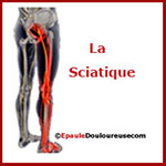 La sciatique