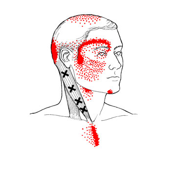 mal de tête, vertigo